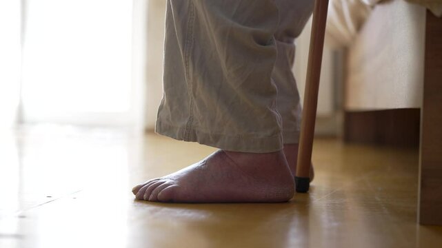 Close-up shot of an elderly person foot with fungal nail infection (onychomycosis), dry skin, and possible circulatory issues. Old man swelling legs and feet. Medical healthcare, diabetes, dermatology