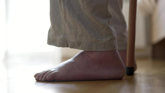 Close-up shot of an elderly person foot with fungal nail infection (onychomycosis), dry skin, and possible circulatory issues. Old man swelling legs and feet. Medical healthcare, diabetes, dermatology
