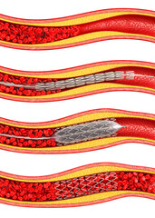 Medical illustration showing balloon angioplasty and stent insertion. 3d illustration