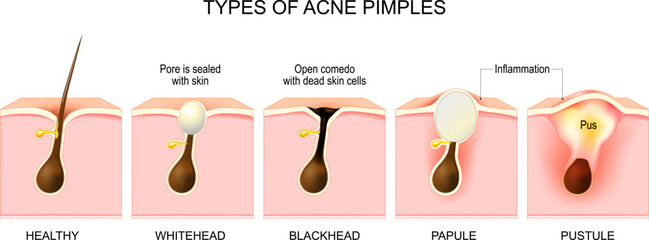 Types of acne pimples. Cross section of skin and hair follicle