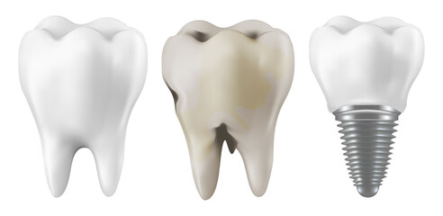 Dental dentists treat teeth decay teeth decay treatment concept. remove plaque, Tooth loss and dental implants . medical apps, websites and hospital. 3D Mesh gradient wes