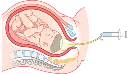 無痛分娩・バルーンのイラスト  Painless childbirth illustration