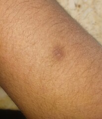 Naklejka premium A person with a rash