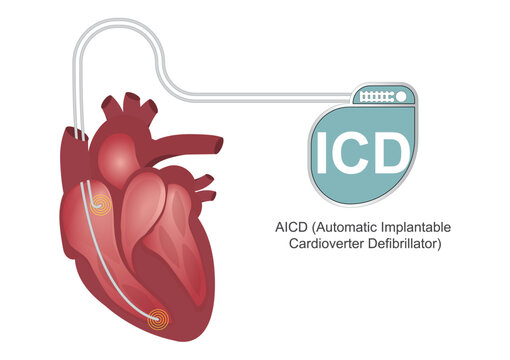 An automated implantable cardioverter defibrillator.