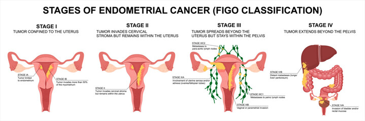 Endometrial cancer stages. FIGO classification of uterine cancer