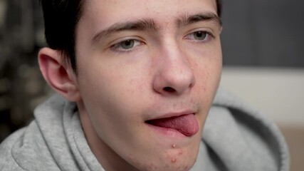 Teenage boy with acne prone skin runs tongue over dry lips. Adolescent male with blemished skin moistens chapped lips with tongue. Young guy with troubled skin slides tongue across cracked lips