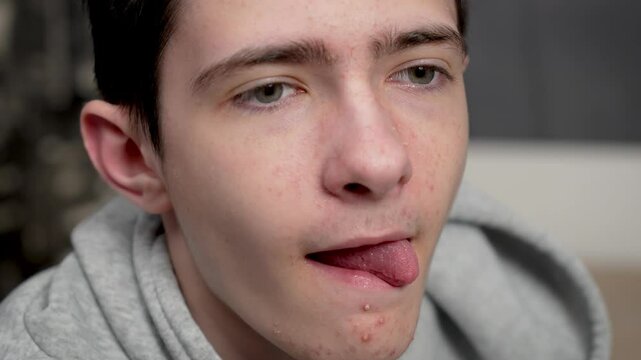 Teenage boy with acne prone skin runs tongue over dry lips. Adolescent male with blemished skin moistens chapped lips with tongue. Young guy with troubled skin slides tongue across cracked lips