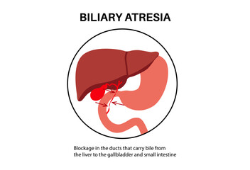 Biliary atresia disease