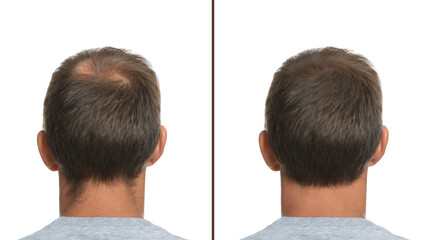 Man suffering from baldness on white background, back view. Collage with photos before and after...