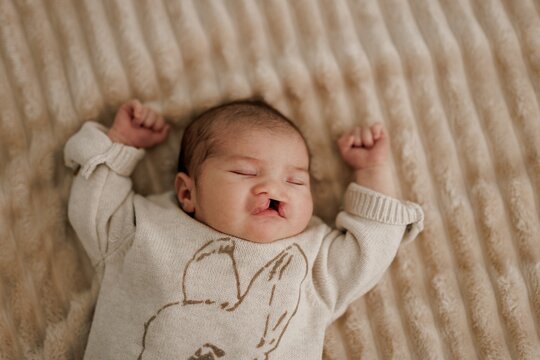 A sleeping newborn baby with congenital defect of cleft lip and palate wrapped in a cozy blanket, resting peacefully in a crib. The baby has a serene expression