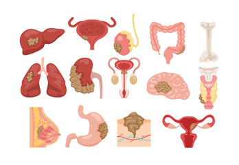 Different types of common cancer, educational medical poster design healthcare, human internal organ liver, bladder, intestine, bone, lung, kidney, testicular, brain, thyroid, breast, stomach, skin.