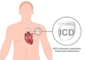 ICD or AICD is an automated implantable cardioverter defibrillator.