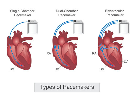 Types of pacemaker.