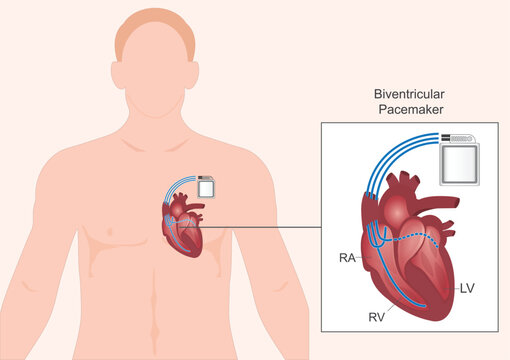 Biventricular pacemakers.Type of pacemaker.