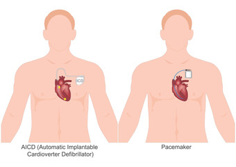 The difference between pacemakers and ICDs.