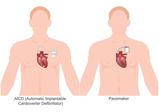 The difference between pacemakers and ICDs.