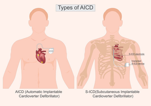 Type of AICD.
