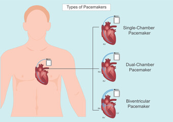 The different types of pacemakers.