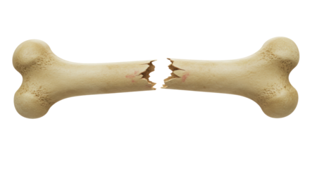 Isolated Broken Bone Fracture Injury