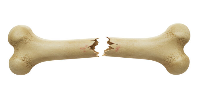 Isolated Broken Bone Fracture Injury