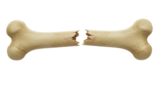 Isolated Broken Bone Fracture Injury
