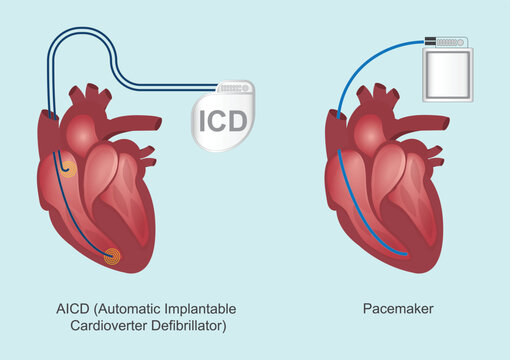 The difference between ICDs and pacemakers.