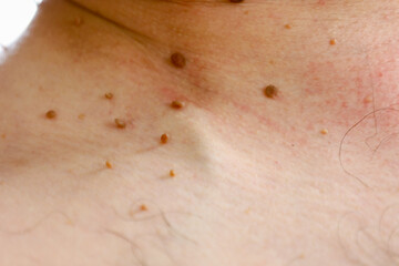 Close-up of human skin with multiple skin tags on the neck and shoulder. Small wart-like growths of various sizes and colors ranging from light brown to darker are visible. The skin has an uneven tone