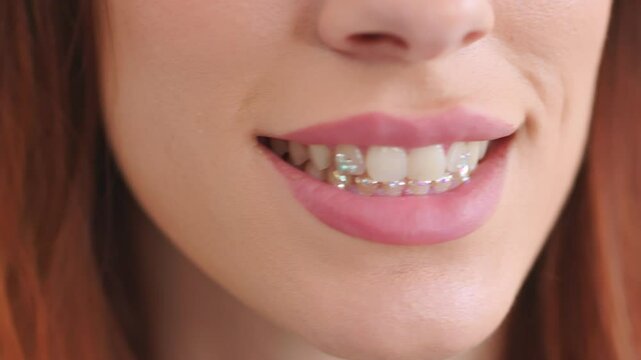 Cropped View Of A Young Woman With Gems Attached To The Surface Of Teeth For Aesthetic Purposes. Close-up Shot