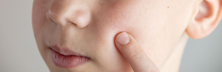 Fototapeta premium Young male teen examines pimple in mirror, highlighting self-image issues and teenage skin concerns