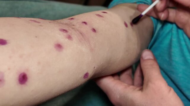 child illness skin rash epidemic with vaccination indoors