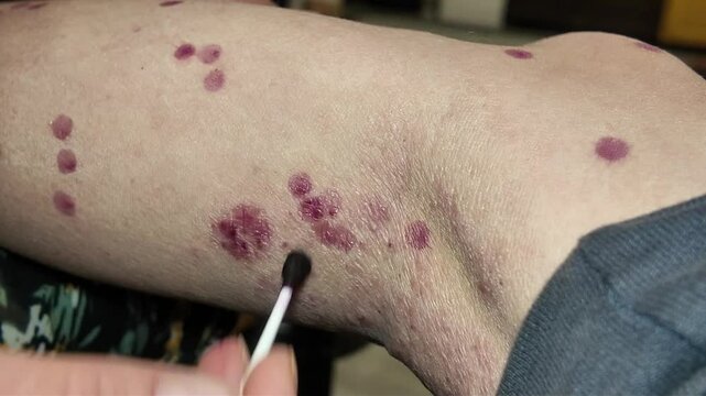 child illness skin rash epidemic with vaccination indoors