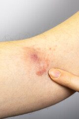 Fototapeta premium Woman showing purulent abscess with irritation and dermatitis on hand. Staphylococcus inflammation. Close up, medical photo.
