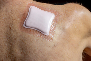 Healthcare and medical, The back side of man with waterproof plaster covered surgical wound after operation, Basal-cell carcinoma (BCC) also known as basal-cell cancer is the most type of skin cancer.