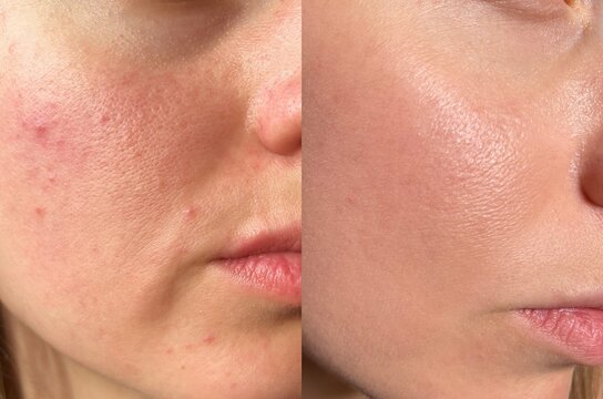 Comparison image of a female face before and after skincare. Visible improvement in pore appearance, acne reduction, and skin glow. Ideal for beauty and dermatology concepts.