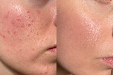 Comparison image of acne-prone face before and after skincare treatment. Shows reduction in...