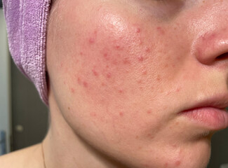 Close-up of a young woman’s face showing acne, clogged pores, and uneven skin texture. Real and...