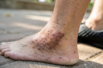 Acanthosis nigricans can cause dark patches on skin, often leading to discomfort and concern