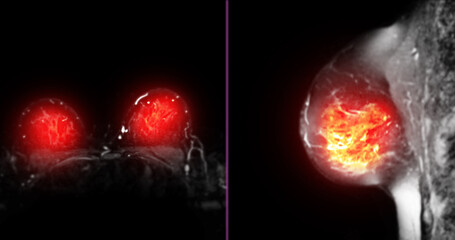 A breast MRI scan with an area highlighted in red, suggesting a potential abnormality that requires further investigation, such as a tumor or cyst.