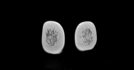 MRI scan of the breasts in an Coronal view with contrast enhancement.