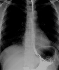 Barium Swallow study test diagnose Barrett's GI tract exam GERD ulcers series difficulty pharynx procedure UGI throat bowel therapy by fluoroscopy devices.