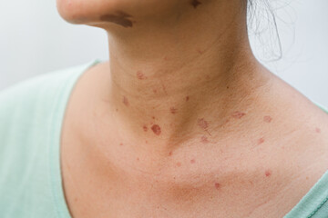 Portrait of a Southeast Asian woman with skin burn marks on her face and neck skin due to hot oil splash while cooking