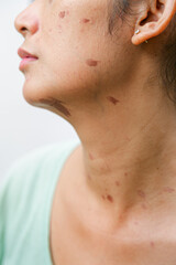 Portrait of an Indonesian woman with skin burn scars on her face and neck skin due to hot oil splatter while cooking