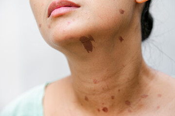 Portrait of a Southeast Asian woman with skin burn marks on her face and neck skin due to hot oil splash while cooking