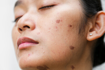 Headshot close-up portrait of an Indonesian woman with skin burn scalds on her facial skin due to boiling water splatter while cooking