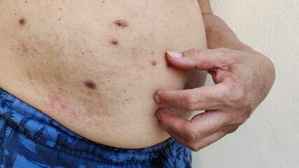 man with stomach pain, scratching the belly, overweight and tummy, waistline and fatty, scar and acne on the body, health care and medical concept.