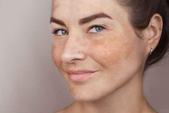 Smiling caucasian woman's face with freckles or age spots, melasma. Close up photo cropped copy space beige background