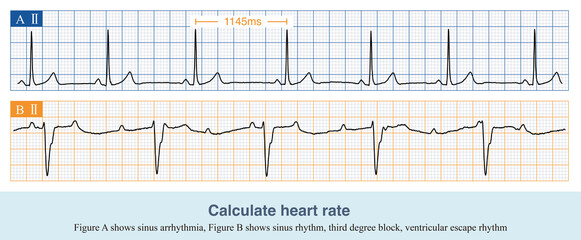 When the atrium and ventricle maintain a 1:1 conduction relationship, the atrial rate and ventricular rate are the same, otherwise they need to be evaluated separately.
