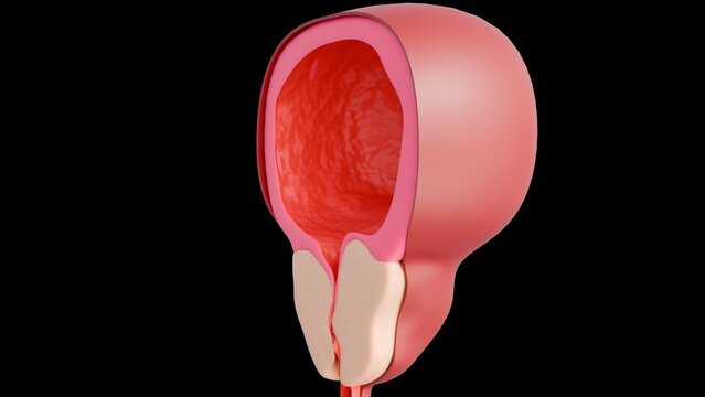 3d rendering of benign prostatic hyperplasia (BPH), a common condition in older men where the prostate gland enlarges, potentially obstructing the flow of urine. 