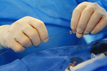 Surgeon's hands during surgery on blood vessels in close-up. Removal of blood clots. Prevention of...