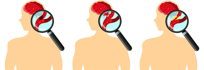 Different types of brain stroke. Ischemic, Hemorrhagic, Transient Ischemic stroke. Types of stroke with magnifying glass isolated on white background. Element for human brain disease and neuroscience.